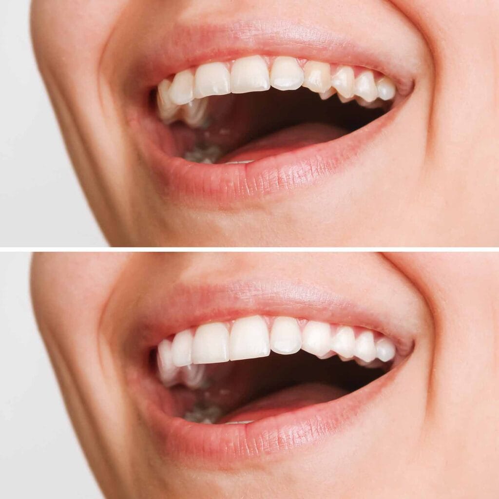 Cost of Dental Implants in Mexico vs USA