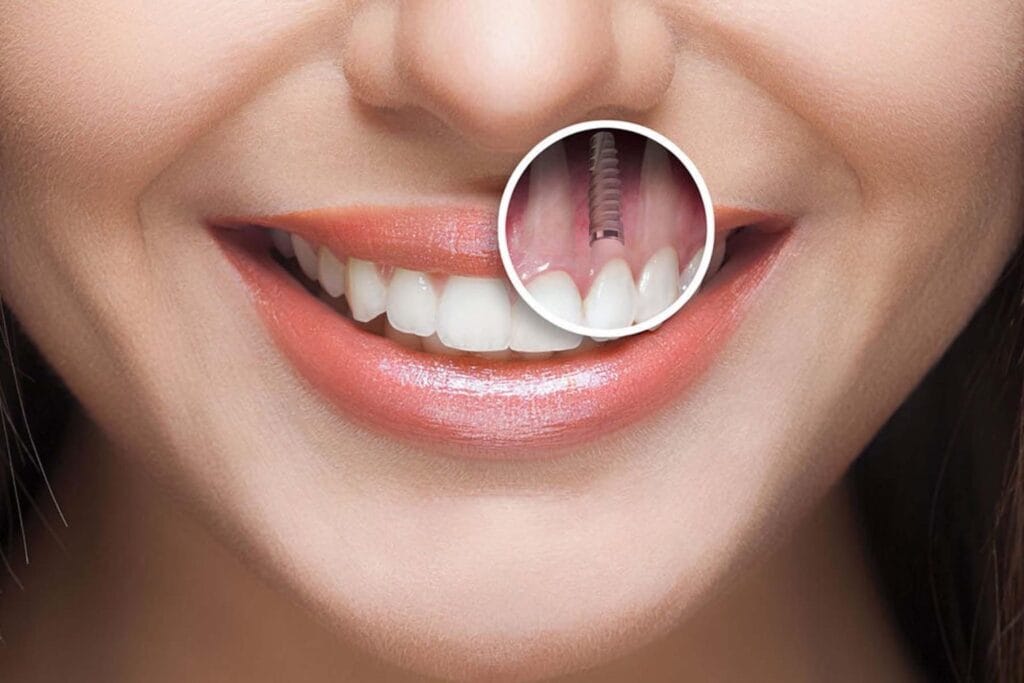 Affordable Dental Implants in Turkey with Synovia Health