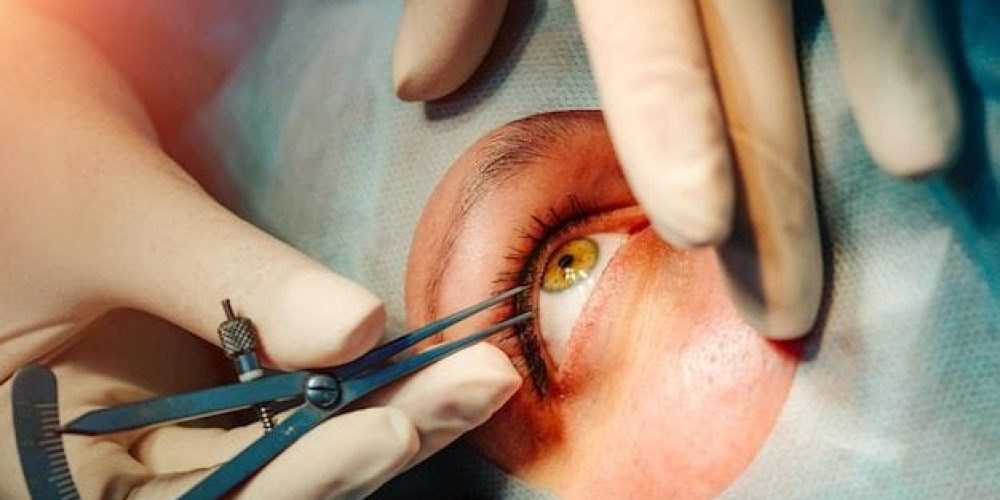 Corneal Transplantation By Synovia Health Corneal Transplantation By Synovia Health