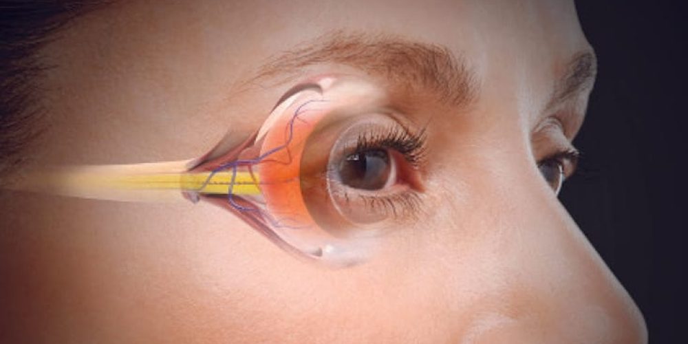 Vision Correction For Presbyopia By Synovia Health Vision Correction For Presbyopia By Synovia Health