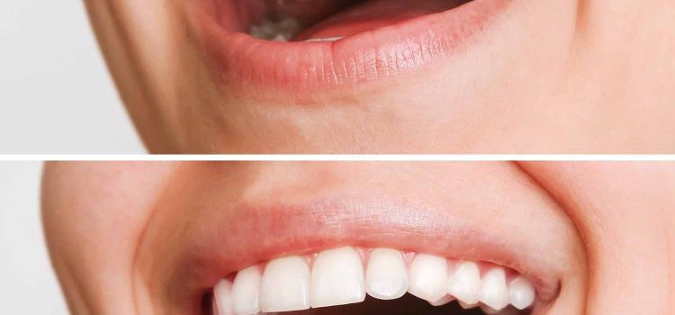 Cost of Dental Implants in Mexico vs USA