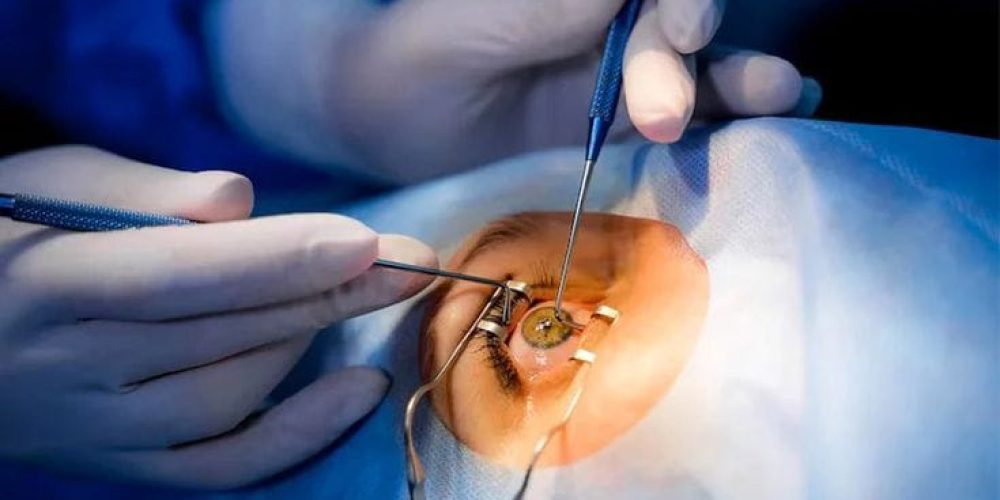Cataract Surgery By Synovia Health Cataract Surgery By Synovia Health
