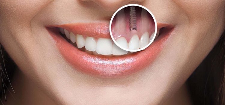 Affordable Dental Implants in Turkey with Synovia Health