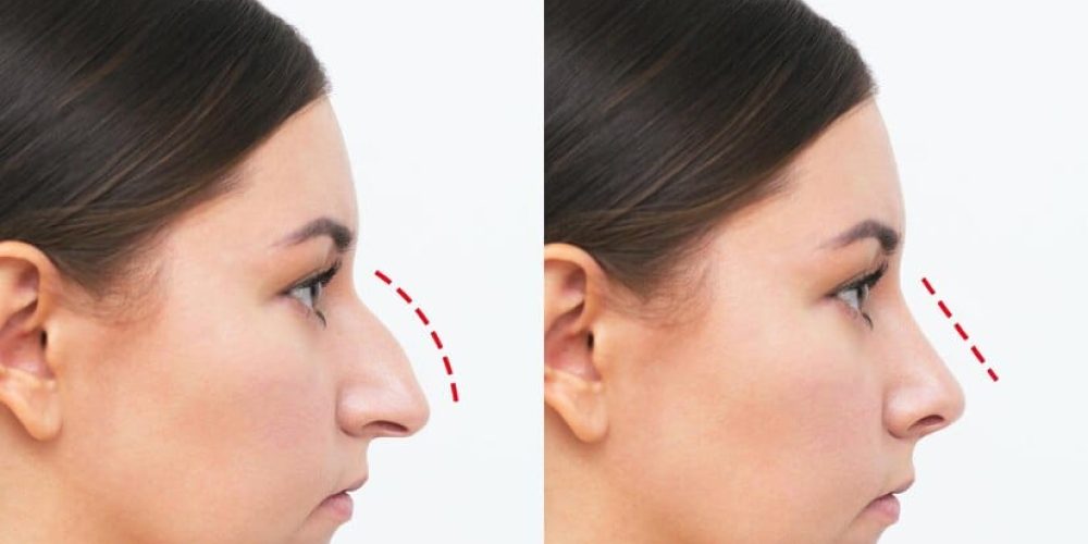 profile-woman-s-face-with-nose-before-after-rhinoplasty-isolated-white-background_753567-17 profile-woman-s-face-with-nose-before-after-rhinoplasty-isolated-white-background_753567-17