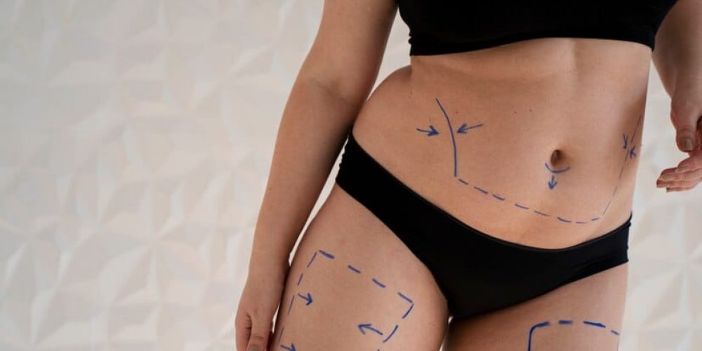 woman-s-body-with-marker-traces-front-view_23-2149350066 Body Contouring By Synovia Health
